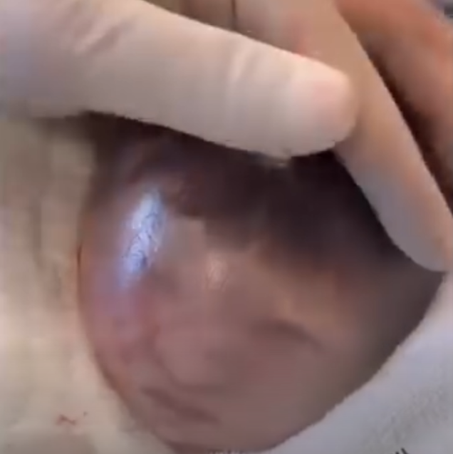 Baby Born Holding Mother’s IUD: A Rare Medical Case That Surprised Doctors Worldwide