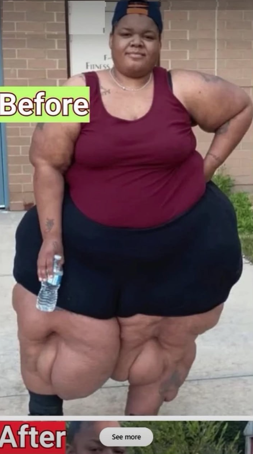 From Misdiagnosis to Strength: A Mother’s Journey with Lymphedema and Lipedema